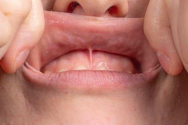 Frenectomy: Ask A Pediatric Dentist About Newborn Lip And Tongue Tie