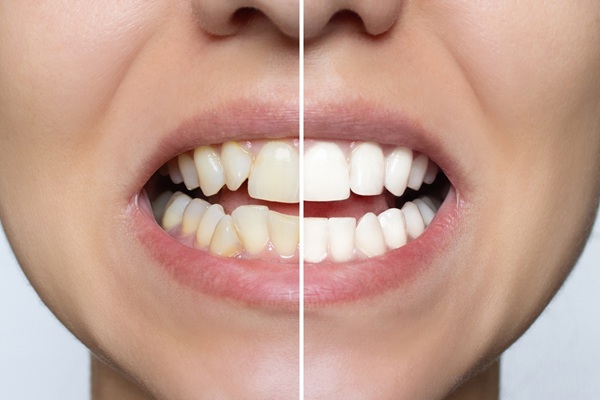 How A Pediatric Dentist Approaches Teeth Whitening